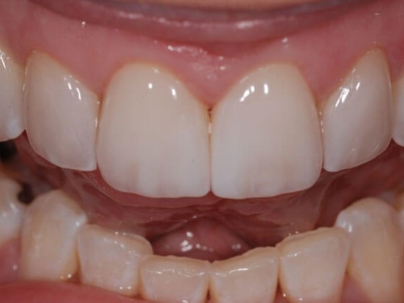 Porcelain Veneers After (close up)
