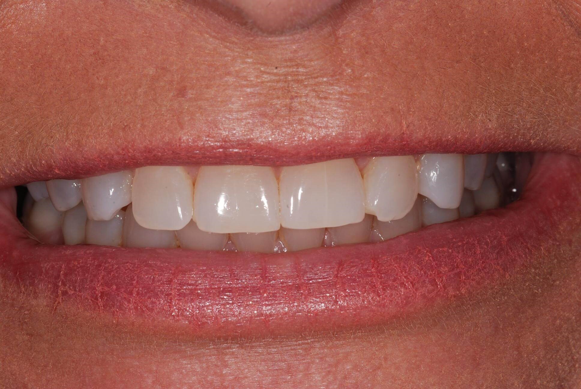 Crowns Before