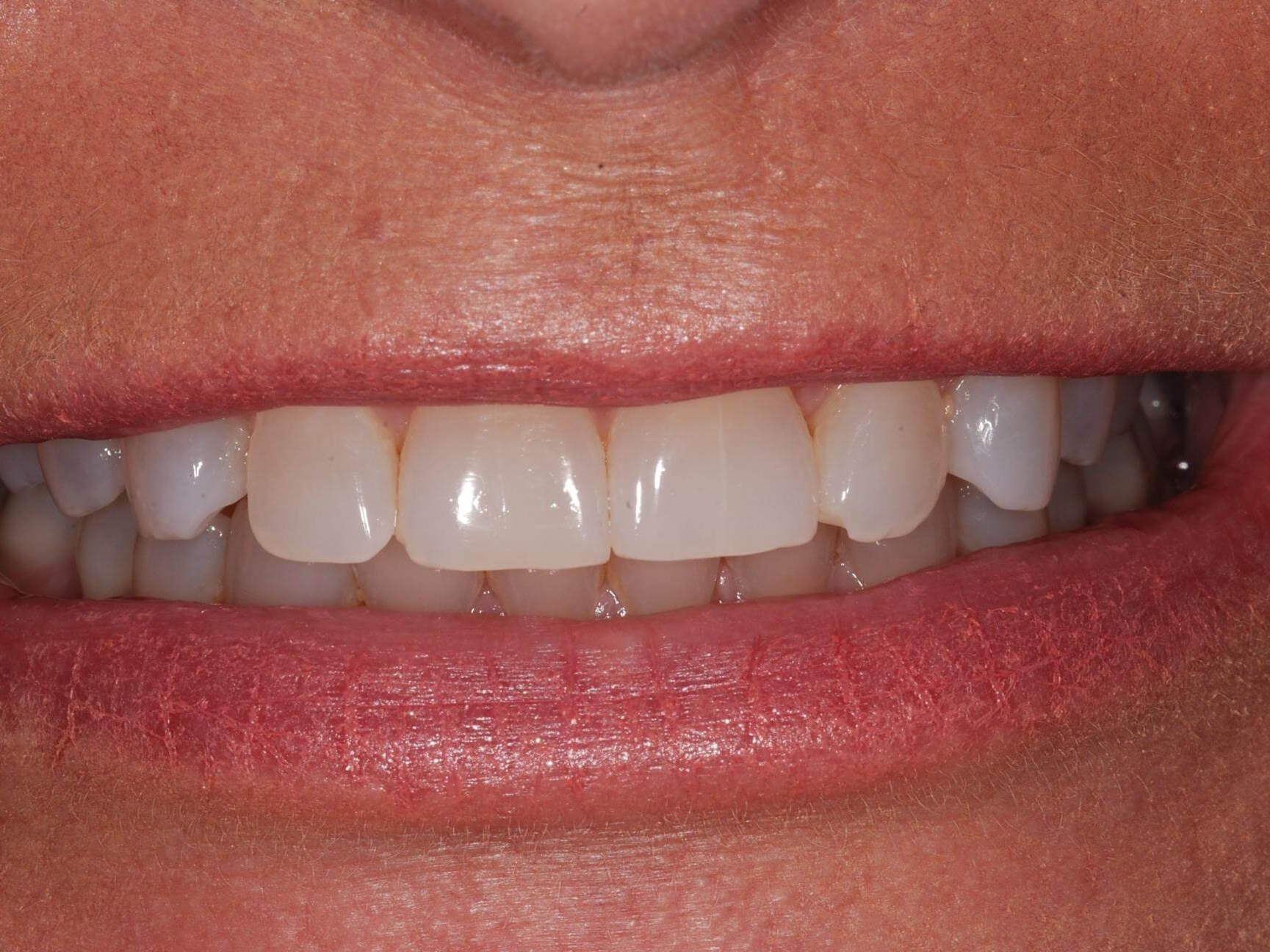 Crowns Before