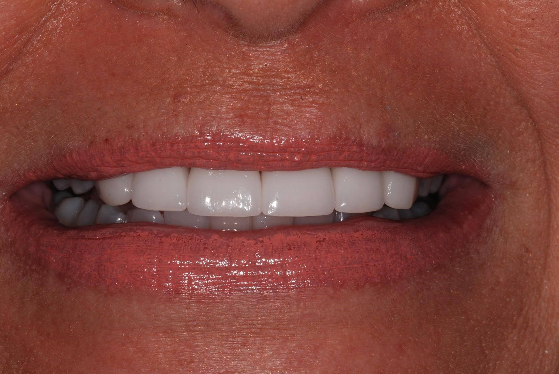Crowns After
