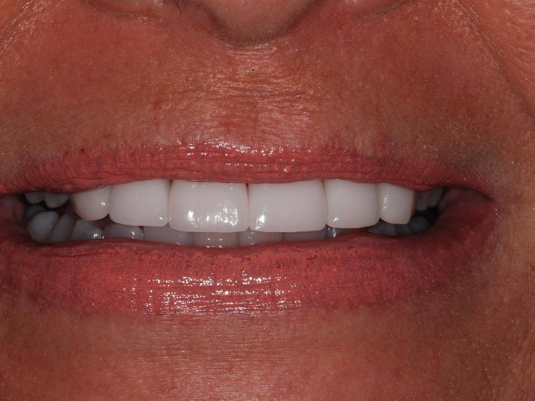Crowns After