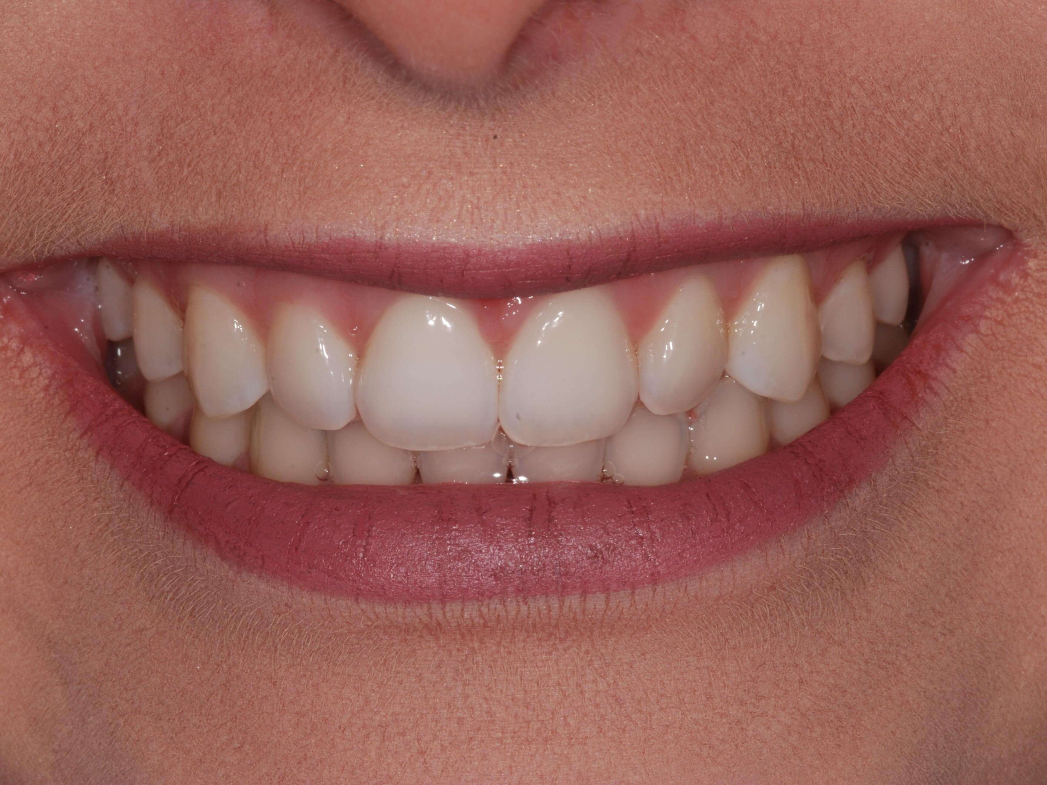 Veneers Before