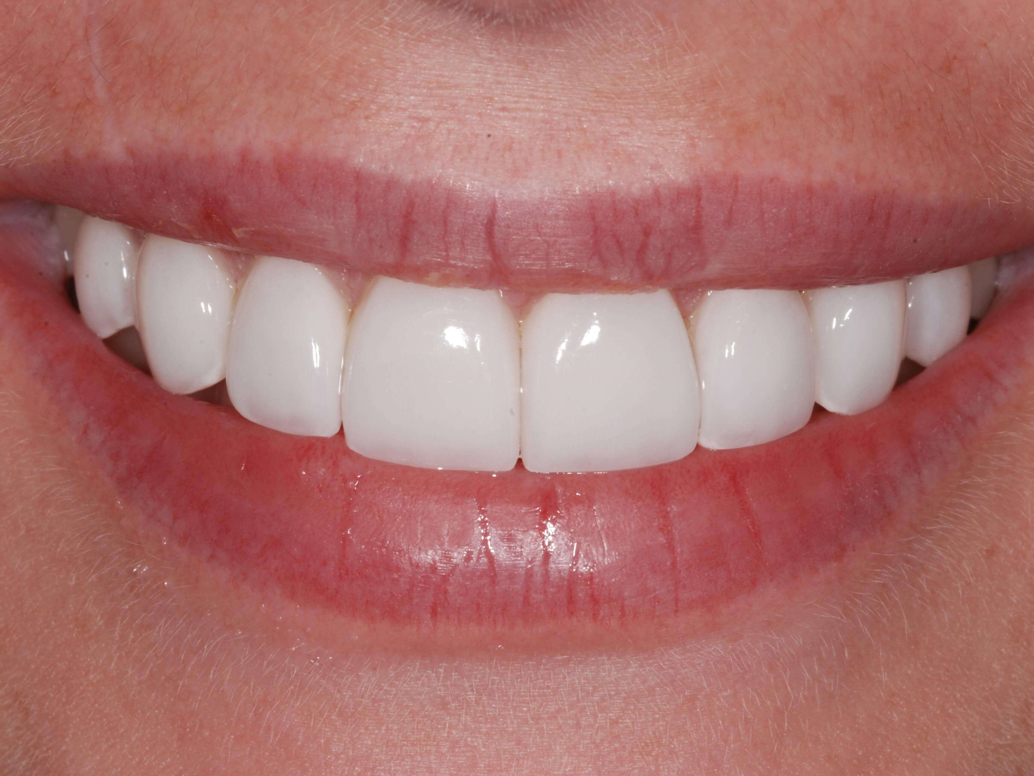 Veneers After